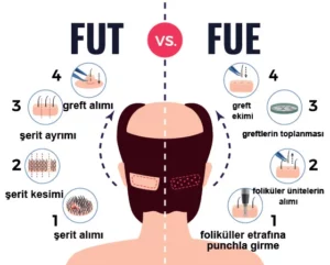 What is Fue Technique Hair Transplant