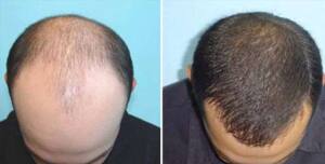 Hair Transplant Before and After