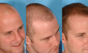 How to Prepare For Hair Transplant