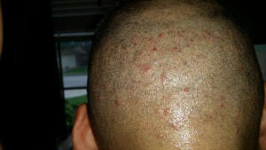 Acne After Hair Transplant